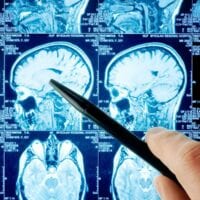 Brain injury lawyer Boone Callaway of San Francisco discusses new MRI scanning technique called diffusion tensor imaging (DTI) that can detect traumatic brain injuries.