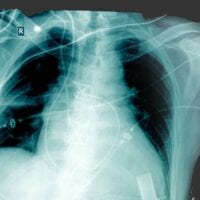 aortic-dissection-medical-malpractice aortic-dissection-medical-malpractice