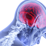 brain injury